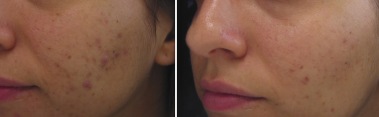 laser treatment of acne