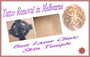 Tattoo Removal at Skin Temple
